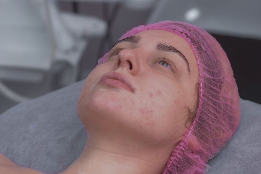 Tratamiento estético del acné: prevención, control de brotes y regeneración de la piel post-acneica