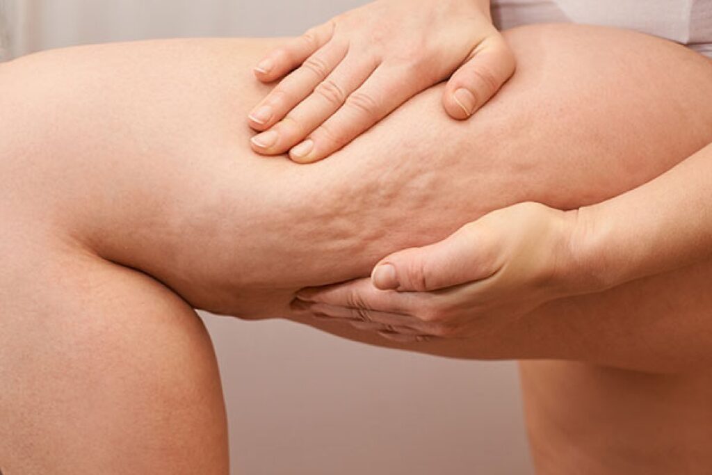 Equipo profesional de estética realizando un tratamiento de presoterapia para la celulitis en piernas.