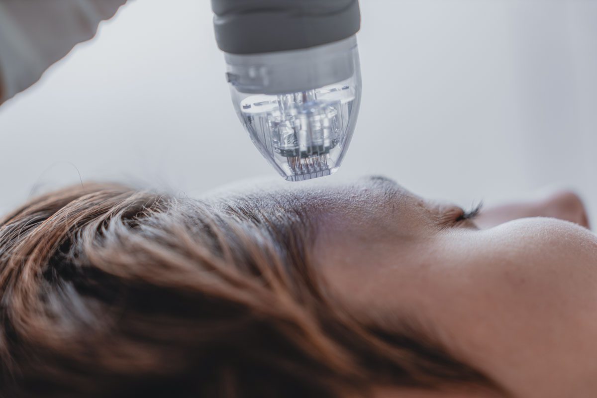 Dermapen: Tratamientos de Microneedling Facial y Corporal