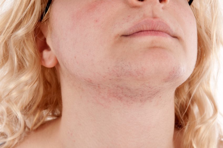 Especialista en estética aplicando un tratamiento de fotodepilación láser como abordaje profesional para reducir el hirsutismo facial.