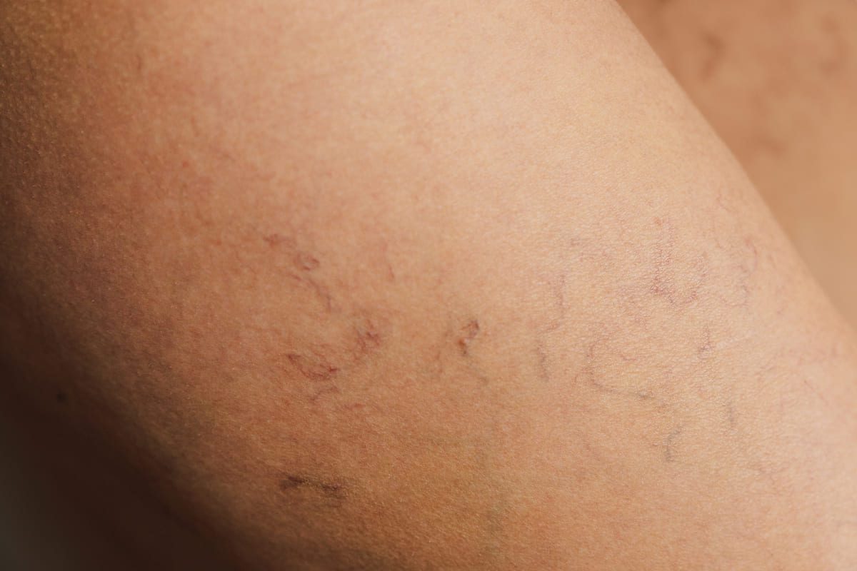 Imagen destacada de “Presoterapia para varices: qué puede y qué no puede hacer”