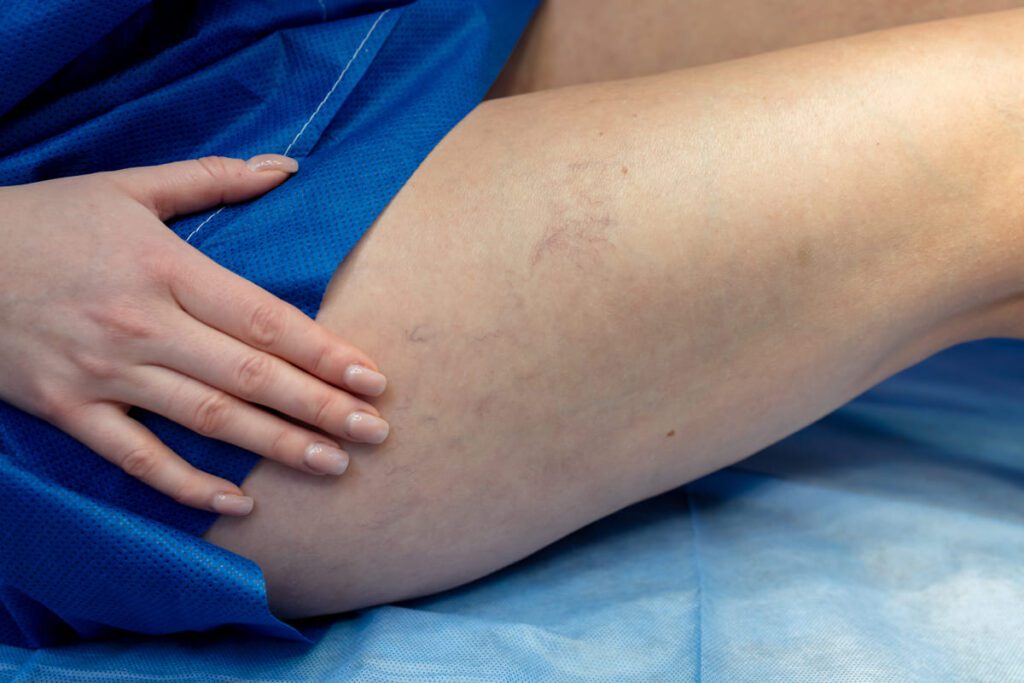 Representación del retorno venoso y alivio de piernas pesadas mediante el uso de presoterapia para varices.