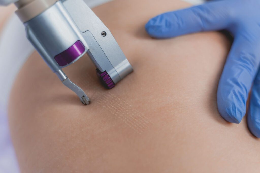 Especialista en Aparatología Corporal: mesoterapia, presoterapia y cavitación estética