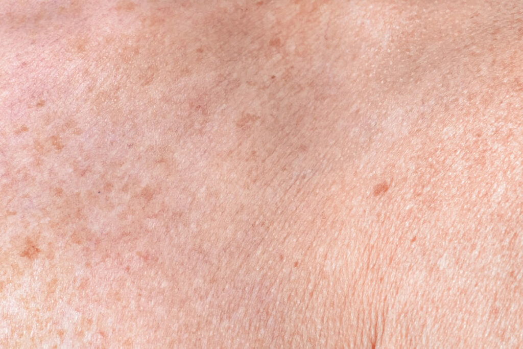 Alteraciones de la piel más comunes melasma