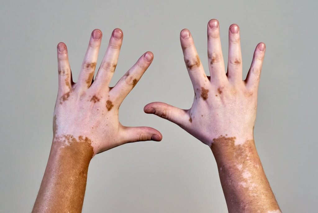 Alteraciones de la piel más comunes vitiligo