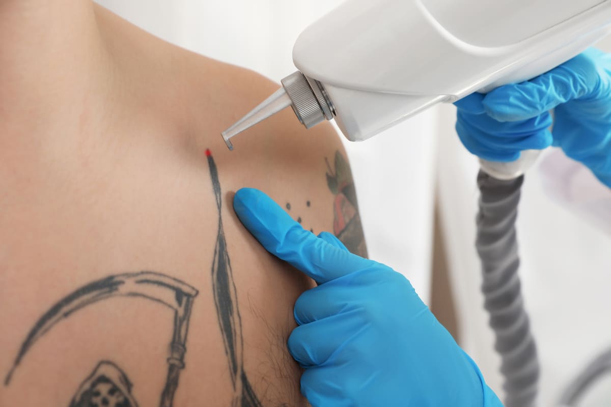 Imagen destacada de “¿Merece la pena especializarse en eliminación de tatuajes con láser? Descubre las oportunidades de esta especialización”